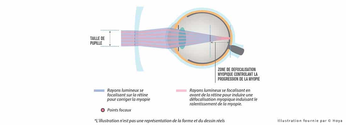 solutions-for-slowing-the progression-of-near-sightedness-or-myopia-hoya-explanatory-diagram