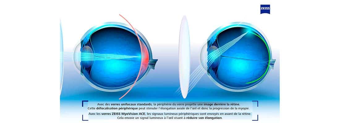 solutions-for-slowing-the progression-of-near-sightedness-or-myopia-zeiss-explanatory-diagram